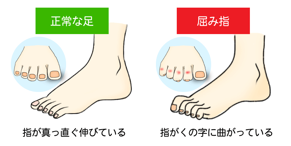 正常な足と屈み指との比較イラスト